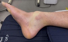 Đánh pickleball suốt 4 tiếng, nam thanh niên 28 tuổi gãy xương chân