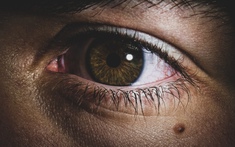 Tưởng nốt ruồi lộc trên mắt hoá ra mắc UNG THƯ DA, bác sĩ sửng sốt: Sai lầm chết người khi coi thường một ‘dấu chấm nhỏ’