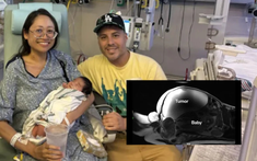 Phép màu y khoa: Em bé chào đời sau 9 tháng phát triển ngoài tử cung, người mẹ không hề biết bản thân mang thai