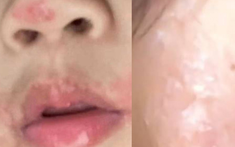 Đi hát karaoke, người phụ nữ nhiễm loại virus không thuốc nào chữa khỏi
