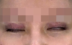 Nữ sinh 22 tuổi mắt không nhắm kín, chảy nước mắt liên tục vì thói quen làm đẹp "bất chấp" của nhiều người
