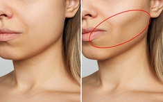 Khuôn mặt lệch, nếp nhăn sớm có thể bắt nguồn từ việc mất răng – Đừng xem nhẹ!