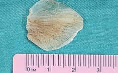 Cảnh báo tai nạn đường tiêu hóa ở trẻ trong dịp hè: Bài học từ vụ bé 2 tuổi uống nhầm bột thông cống