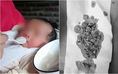 Bé gái 5 tháng tuổi đến viện với chiếc bụng toàn sỏi, bác sĩ kinh hoàng khi biết việc bố mẹ làm từ lúc bé mới sinh 3 ngày
