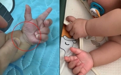 Thấy bàn tay bụ bẫm của con có 1 "chi tiết lạ", mẹ Việt lên mạng mới biết con có "dấu hiệu dị tật", cần đến khám bác sĩ Nhi gấp