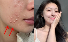 5 kem chấm mụn "thần thánh": link bong da truc tiep xẹp mụn nhanh link bong da truc tiep ngừa thâm hiệu quả