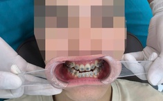 Trầm cảm vì niềng răng 3 năm vẫn "hô như ngày đầu"