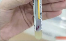 Máu "đặc quánh như sữa chua" vì 3 thú vui nhiều người có