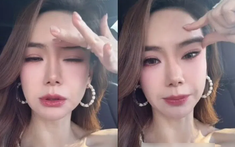 Nữ diễn viên nổi tiếng thừa nhận gương mặt "cứng đờ" vì tiêm botox quá liều, bác sĩ cảnh báo: 0,00000005 gram chất này có thể gây tử vong