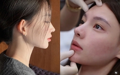 Những dấu hiệu bạn đang bị biến chứng sau khi làm mũi