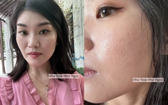 Tôi đã trẻ hóa truc tiep bong da c1 thành công nhờ collagen, mất đúng 2 năm để thay đổi làn truc tiep bong da c1 sẹo rỗ
