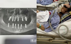 Cụ ông 77 tuổi qua đời sau khi cấy 6 implant và nhổ 12 răng: Có phải càng nhiều tuổi càng không nên nhổ răng, cấy implant?