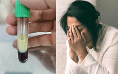 Người phụ nữ 42 tuổi máu nhiễm mỡ trắng xóa, nguy cơ viêm tụy cấp vì sáng nào cũng uống thứ nước nhiều người Việt mê mẩn
