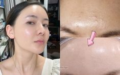 Thạc sĩ 36 tuổi chia sẻ hành trình trị mụn ẩn khoa học: Da sần sùi hóa láng mịn chỉ nhờ hiểu đúng
