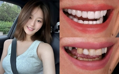 Đừng để răng sứ "làm hỏng nụ cười" khi mắc phải những sai lầm cơ bản này