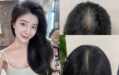 Tóc từng rụng không kiểm soát, người phụ nữ này đã "hồi sinh" từng sợi bằng thói quen đơn giản
