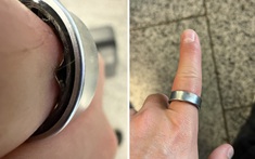Galaxy Ring bị phồng pin, kẹt trên ngón tay Youtuber và phải vào bệnh viện để tháo ra