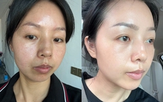 Người phụ nữ này mất 2 năm tự dưỡng tại nhà để giúp làn truc tiep bong da vtv6 "thoát" nám