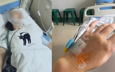 Dầm mưa 10 phút, người phụ nữ bị viêm màng não