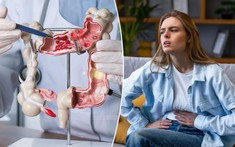 Không phải di truyền, chính những món quen thuộc này có thể đang "nuôi lớn" ung thư đại trực tràng ở phụ nữ trẻ