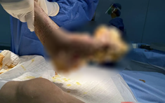 Người đàn ông suýt mất cả bàn chân vì nhiễm HPV