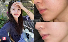Vì sao da lão hóa khiến collagen giảm nhanh, lộ rõ nếp nhăn vào mùa thu?