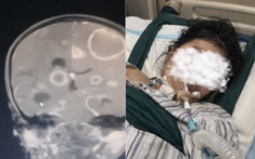 Dọn dẹp nhà đón Tết, bé gái lớp 2 bị "ăn mòn 20 lỗ thủng" ở não