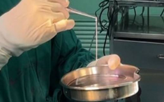 Người phụ nữ 32 tuổi đi ngoài ra sán dài tới 3 mét dù chưa từng ăn đồ sống, bác sĩ chỉ ra 1 thứ bếp nhà nào cũng có chính là thủ phạm