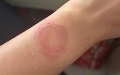 Người dùng Apple Watch phản ánh bị bỏng nặng và gặp khó khăn khi liên hệ hỗ trợ suốt 6 tháng