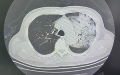 Người đàn ông sốt 40 độ C, phổi gần như 'trắng xóa", chỉ vài ngày đã suy đa tạng: Thủ phạm liên quan đến thói quen nhiều gia đình vẫn mắc