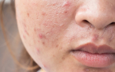 Routine chăm sóc da dầu mụn đơn giản tại nhà: 3 bước khoa học cùng Actidem