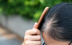 Người trẻ tóc bạc sớm: Bác sĩ chỉ ra 3 dưỡng chất hay bị thiếu hụt, ít người để ý đến