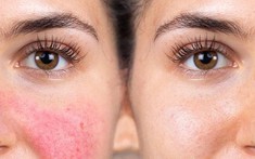 Hydroquinone - Trắng hồng nhanh nhưng chưa chắc an toàn