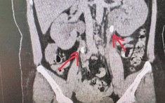 Bác sĩ giật mình khi xem hình ảnh CT thận của bệnh nhân