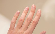 Kiểm tra móng tay ngay xem có dấu hiệu này không - nếu có phải đi khám!
