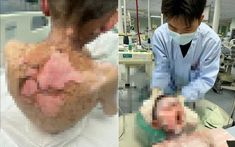 Bé trai 9 tuổi bong tróc da, loét khắp cơ thể, vảy dính kín mắt miệng, nguyên nhân từ 1 loại thuốc thông dụng trong mọi gia đình