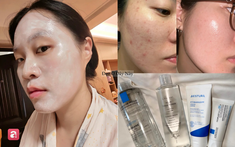 Da mẩn đỏ, lỗ chân lông to cải thiện rõ rệt nhờ routine skincare chỉ vỏn vẹn 4 bước