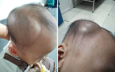 1 mẹ bỉm chia sẻ diễn biến âm thầm nhưng nguy hiểm sau cú ngã của con: Đừng chủ quan kể cả khi bé có vẻ vẫn bình thường