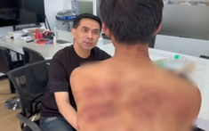 Nam thanh niên đi làm với mình mẩy thâm tím, sếp hỏi chuyện mới phát hiện nhân viên bị mẹ kế bạo hành
