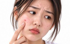 Có nên dùng chấm mụn hằng ngày không?