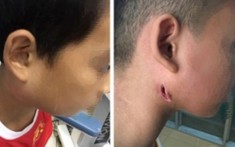 Một trong 2 bé trai mắc vi khuẩn ăn thịt người - Whitmore sau khi dầm nước mưa, có biểu hiện rất nặng