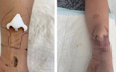 Mất chiếc mũi cũ vì bị ung thư, người phụ nữ được 'hồi sinh mũi' vì ghép nuôi trên cánh tay