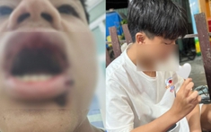Nam sinh 14 tuổi bị đánh gãy răng, nhấn xuống nước khi đi tắm biển tại Đà Nẵng