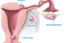 Bệnh viện Phụ sản MêKông xử lý thành công ca thai bám ở cổ tử cung, một trường hợp hiếm gặp và nguy hiểm