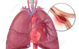 Cứu sống người bệnh thuyên tắc phổi nguy kịch do sử dụng thuốc tránh thai kéo dài 