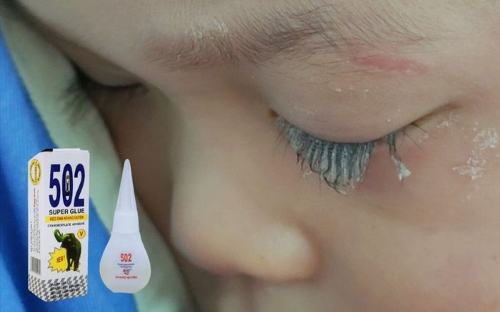 Bé trai 3 tuổi bị keo 502 bắn vào mắt, hành động của người mẹ trong “30 giây vàng” đã cứu con khỏi cảnh mù loà!